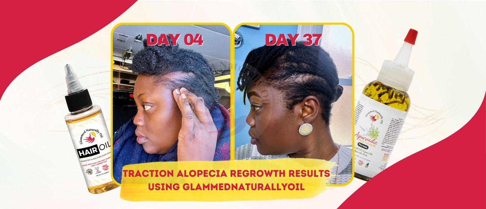 5 weeks Regrowth Traction Alopecia Journey - GlammedNaturallyOil
