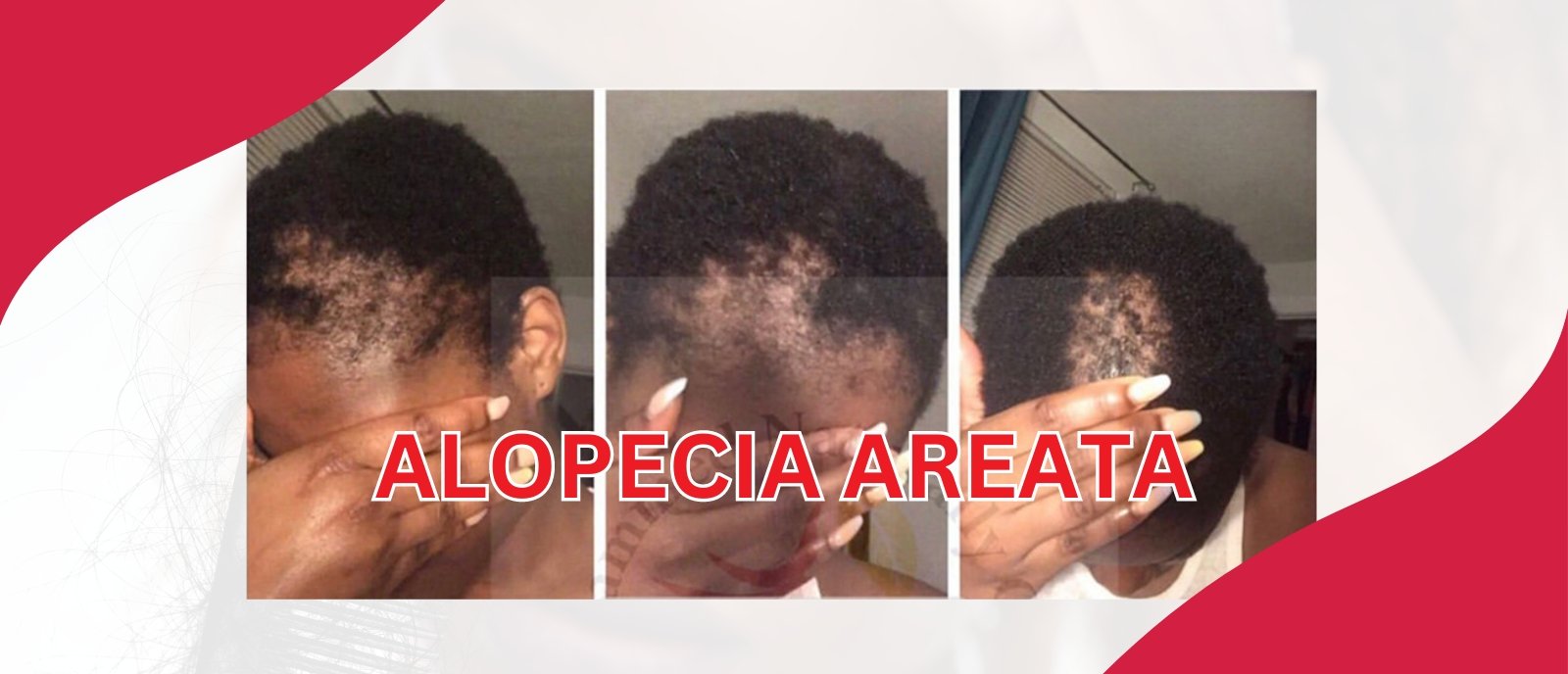 Alopecia Areata - GlammedNaturallyOil