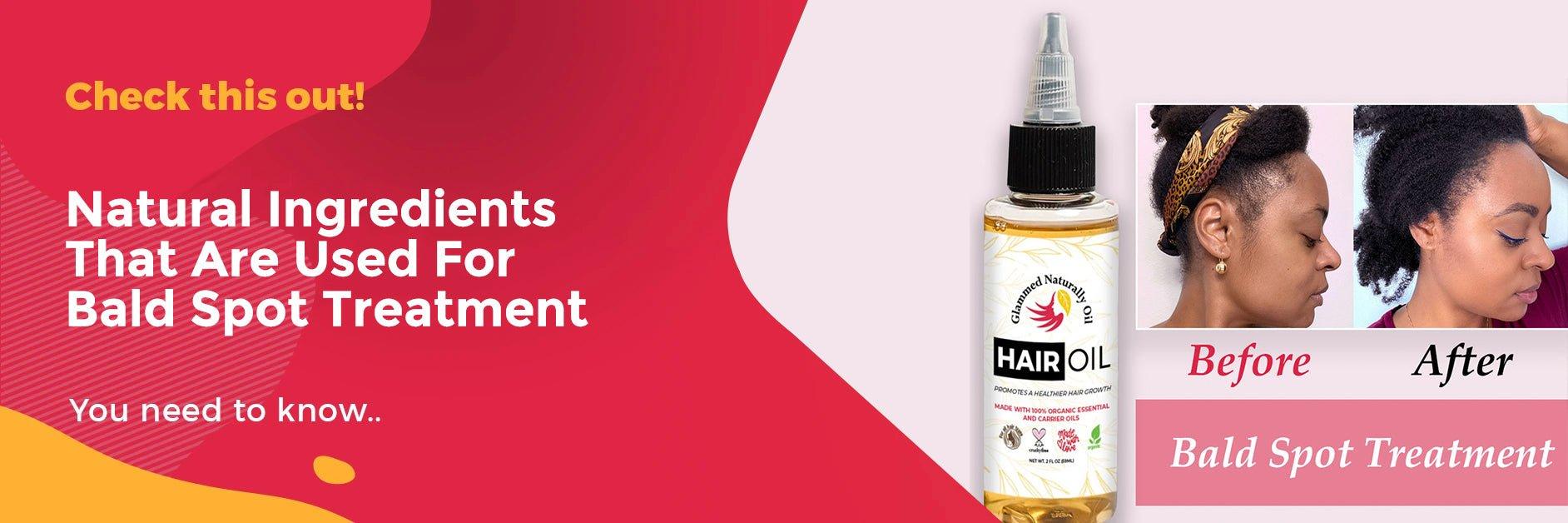 Natural Ingredients That Are Used For Bald Spot Treatment - GlammedNaturallyOil